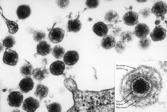 Cytomegalie @ wikimedia.org